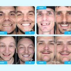 SMILEFIT PRO – SET DI DENTIERE REGOLABILI PER UN SORRISO PERFETTO