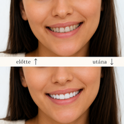 SMILEFIT PRO – SET DI DENTIERE REGOLABILI PER UN SORRISO PERFETTO