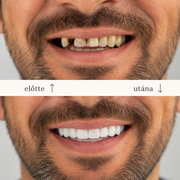 SMILEFIT PRO – SET DI DENTIERE REGOLABILI PER UN SORRISO PERFETTO