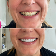 SMILEFIT PRO – SET DI DENTIERE REGOLABILI PER UN SORRISO PERFETTO